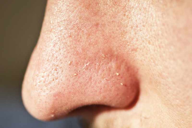 Cara Menghilangkan Bruntusan Di Hidung Dengan Cepat